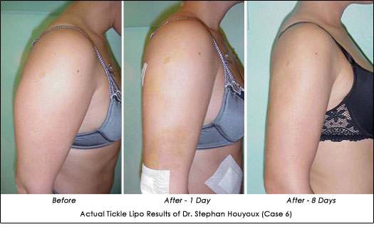 Laser Body Contouring - Before and After