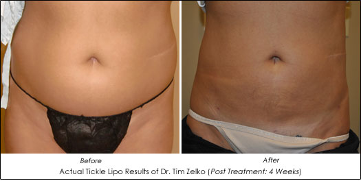 Tickle Lipo Results
