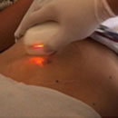 A new skin tightening treatment using RF technology rather than light energy is now available in the US.