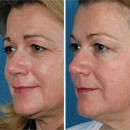 The Triniti 3-In-1 Laser Treats Spots, Wrinkles, and Tightens Skin