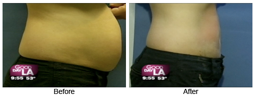 Are There Alternatives To A Tummy Tuck? - AHB