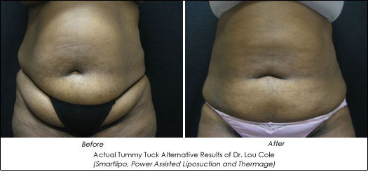 Can I Get a Tummy Tuck Without Liposuction?