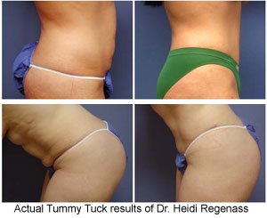 tummy tuck before and after