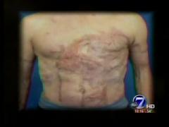 Laser for Treating Burn Scars