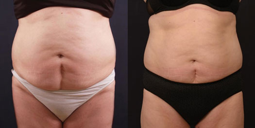 Vanquish Fat Reduction in Toronto