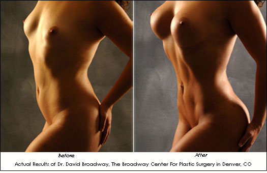 vaser before and after