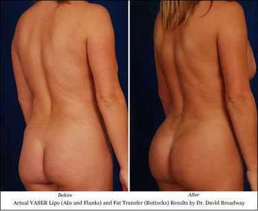 vaser lipo and brazilian butt lift dr. david broadway