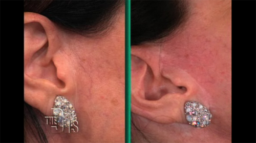 vein gogh before and after