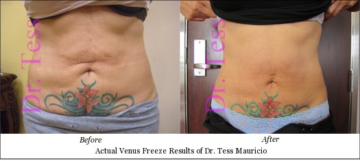 Start Venus Freeze Plus™ Body Contouring and Skin Tightening Now