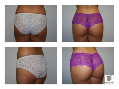 Brazilian Butt Lift