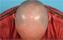 NeoGraft FUE Hair Transplant