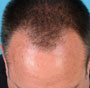 NeoGraft FUE Hair Transplant