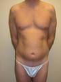 49 yo SmartLipo For Fat Reduction