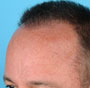 NeoGraft FUE Hair Transplant