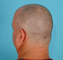 NeoGraft FUE Hair Transplant