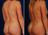 VASER Lipo and Brazilian Butt Lift