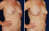 Natural Breast Augmentation