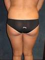 34 year old Hispanic woman with SmartLipo