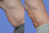 Liposuction, SmartLipo, Laser Lipolysis