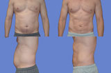 Liposuction, Laser Lipolysis, SmartLipo