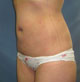 Liposuction, Laser Lipolysis, Tickle Lipo, Lipolite