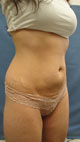 Liposuction, SmartLipo, Laser Lipolysis, Tickle Lipo