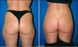 Buttocks Augmentation using Fat Transfer by Dr. Thomas Barnes