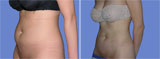 SmartLipo Results by Dr. Robert Burke