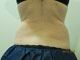 Actual Coolsculpting Patient - Results by Dr. John Tang