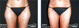 Liposuction to Thighs performed by Dr. Lornell Hansen