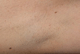 Laser Hair Removal