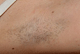 Laser Hair Removal