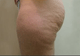 Body Contouring Utilizing VelaShape III