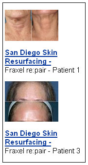 Before and After Photos of Fraxel